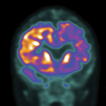 PET/CT scan