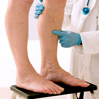 vein care