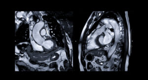 Cardiac MRI at Radiology and Imaging Specialists at Lakeland Regional Health